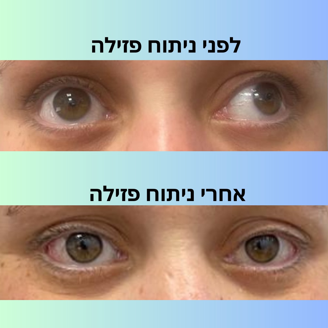 Strabismus