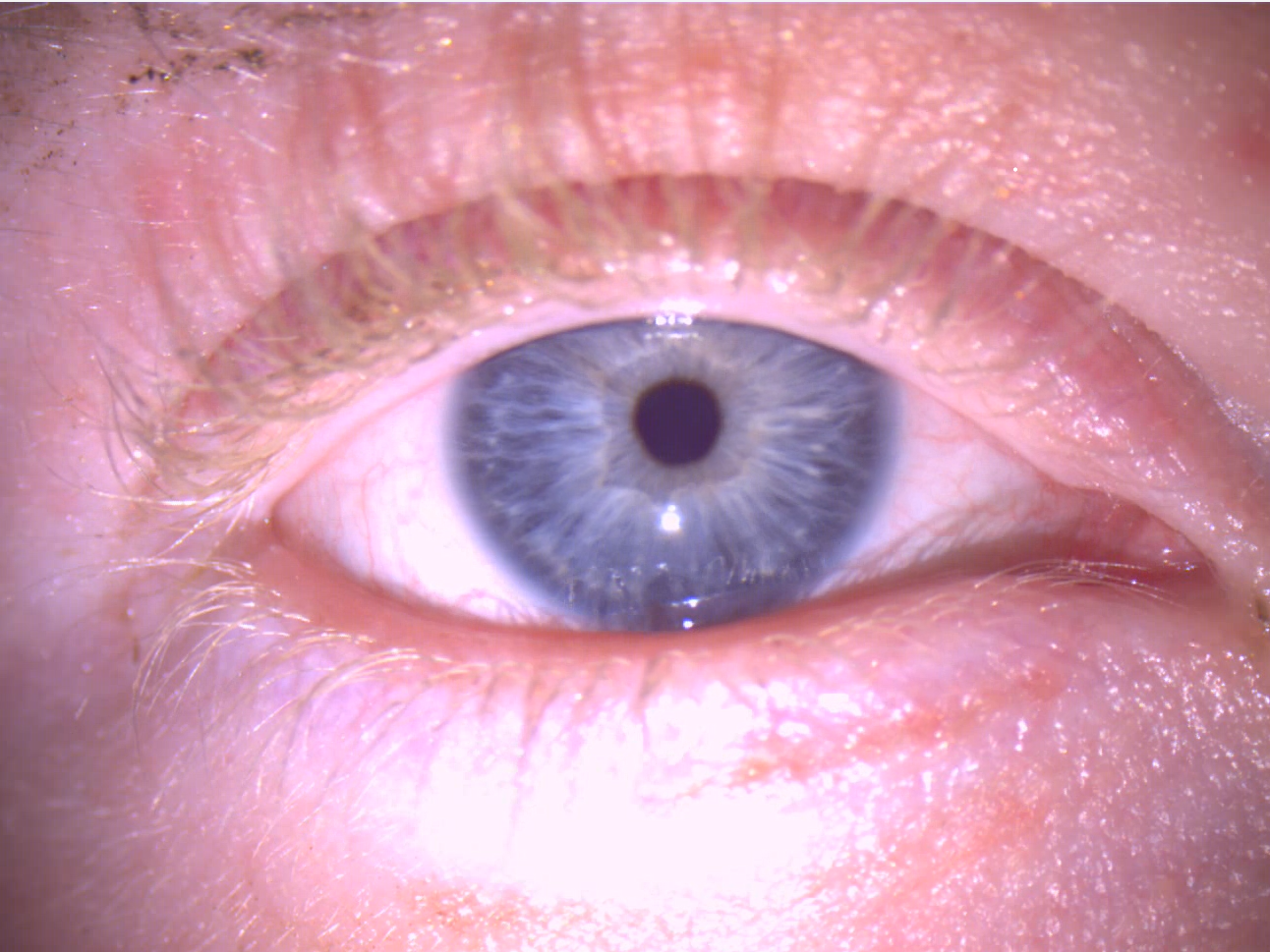 Nystagmus: the phenomenon that causes the eyes to move involuntarily