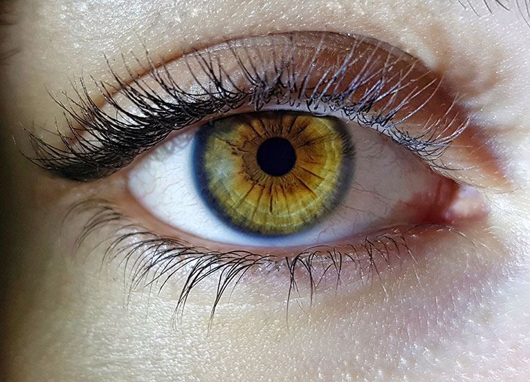 מחלת הניסטגמוס והטיפול בעיניים מרצדות - פודקאסט
